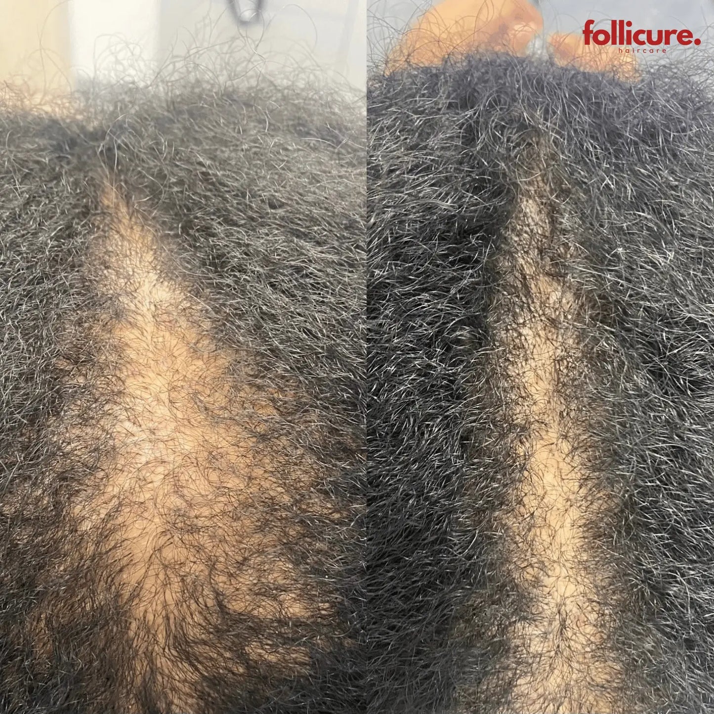 Follicure⢠RevivaBrush