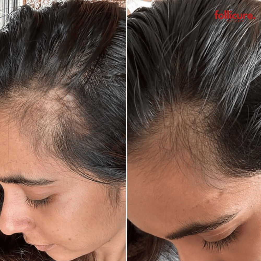 Follicure™ RevivaBrush